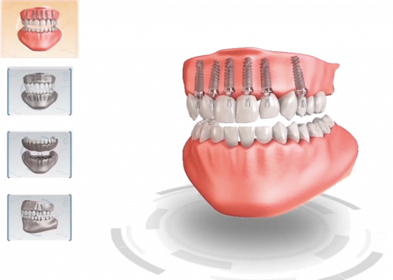 ilustración Carga inmediata, clinica dental Verona