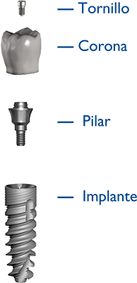 Implante dental ilustracion min