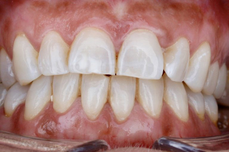 Antes y Despues de Carillas Dentales 01 2