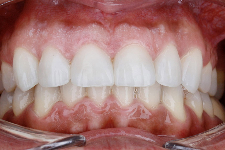 Antes y Despues de Carillas Dentales 02 2