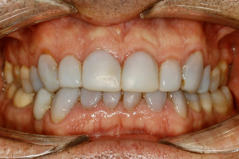 Antes y Despues de Carillas Dentales 03 1