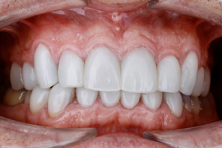 Antes y Despues de Carillas Dentales 03 2