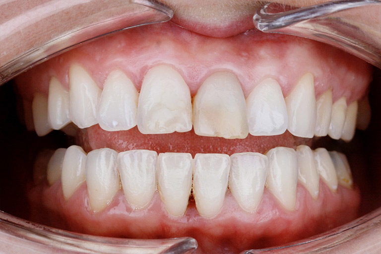 Antes y Despues de Carillas Dentales 04 1