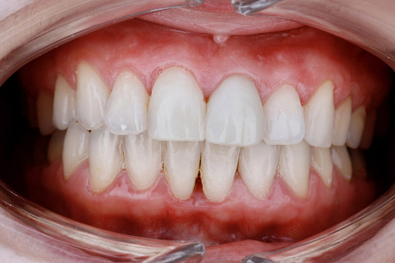 Antes y Despues de Carillas Dentales 04 2