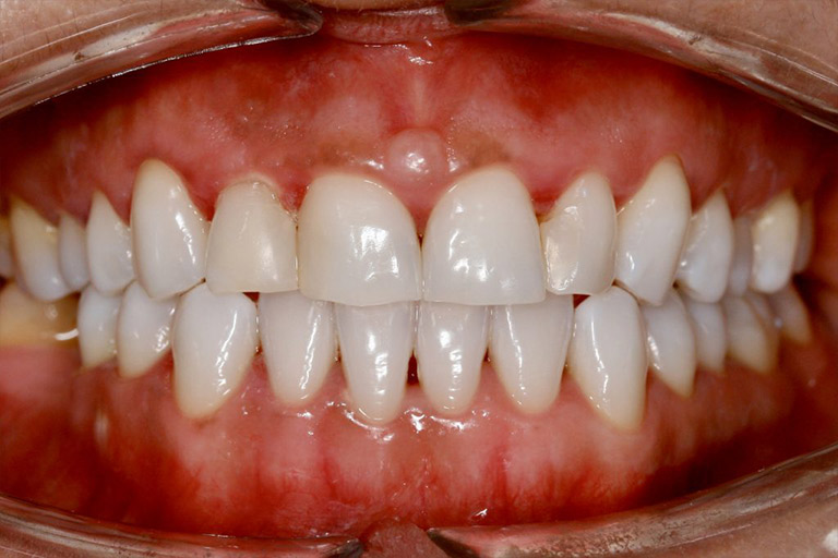 Antes y Despues de Carillas Dentales 05 1