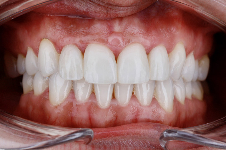 Antes y Despues de Carillas Dentales 05 2