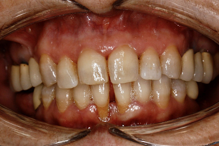 Antes y Despues de Carillas Dentales 06 1