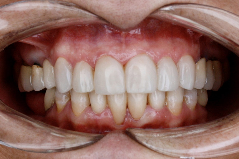 Antes y Despues de Carillas Dentales 06 2